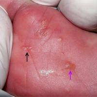 
	Scabies - plantar foot

	Burrow (black arrow)…