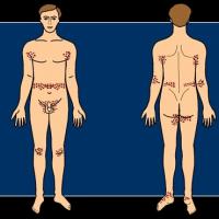 
	Distribution of scabetic papules and…