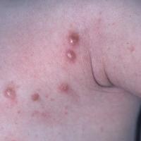 
	Scabetic nodules in an infant