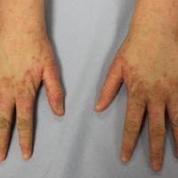 Hyperkeratotic scabiesThis patients hands had…