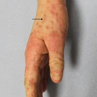 
	As previous image 

	Burrow present (arrow)