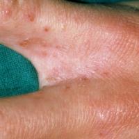 
	Scabies - finger webs 