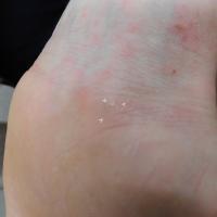 Scabies burrowCopied with kind permission from Dr…