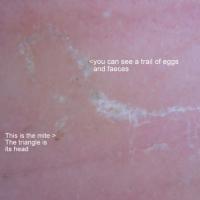 
	Same patient as previous image - dermoscopic…