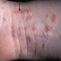 
	Scabies

	The arrow denotes a burrow