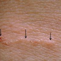 
	Scabies burrow close-up