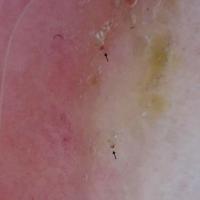 
	Dermoscopic appearance of scabies mites

	The…