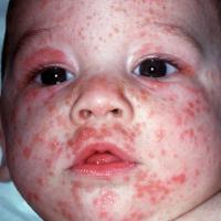 
	Scabies with facial involvement in an infant