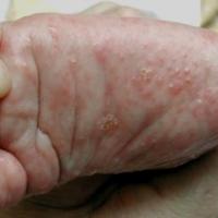 
	Scabies - plantar foot

	Normally only a…