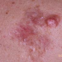 
	Dermatofibrosarcoma protuberans&nbsp;

	Copied…