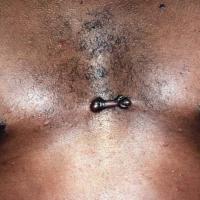 
	Keloid scar - dumbbell appearance 