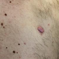 
	Scar following the excision of a seborrhoeic…