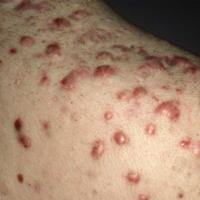 
	Many scars - severe acne