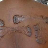 
	Severe keloid scars - secondary to scratching 