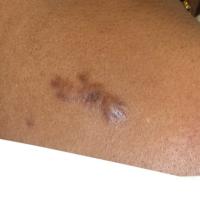 
	Keloid scar - chickenpox