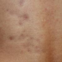 
	Atrophoderma of Pasini and Pierini