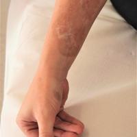 
	Linear morphoea

	Only affecting right arm from…