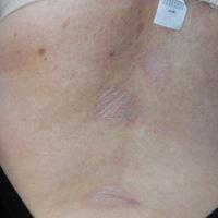 
	Non-genital lichen sclerosus

	White…