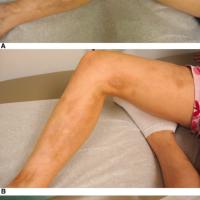 
	Linear morphoea treated with methotrexate and…