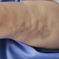 
	Subcutaneous (deep) morphoea