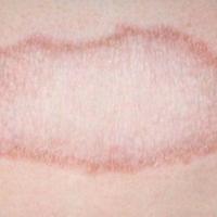 
	Tuberculoid leprosy 

	One to several…