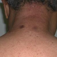 
	Scleredema of the neck