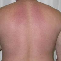 
	Scleredema in a diabetic patient&nbsp;