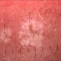Dermoscopic appearance of previous…