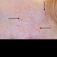 Sebaceous gland hyperplasiaCopied with kind…