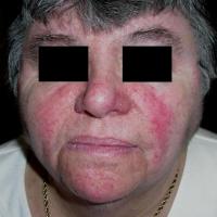 
	Seborrhoeic eczema

	Erythema of the central…