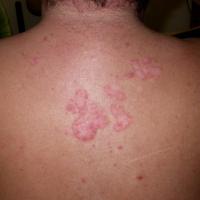 
	Seborrhoeic&nbsp;eczema&nbsp;on the…