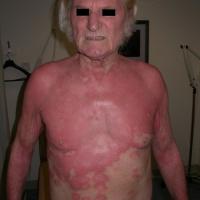 
	Extensive seborrhoeic&nbsp;eczema