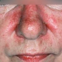 
	Seborrhoeic&nbsp;eczema

	Central face