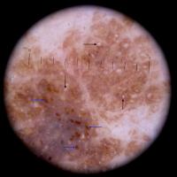 Dermoscopic appearance of previous…