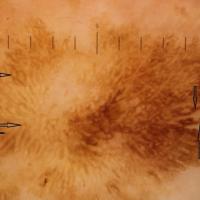 Dermoscopic appearance of previous figureMany…