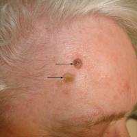 
	Seborrhoeic keratoses on the…