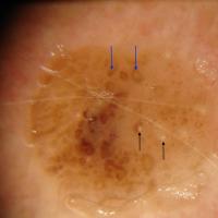 Dermoscopic appearance of previous…