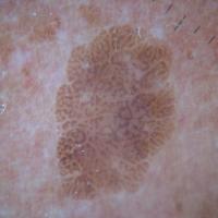 
	Seborrhoeic keratosis
	
	Multiple fissures…