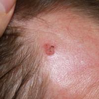 Seborrhoeic keratosis on the right templeCopied…