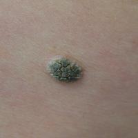 Seborrhoeic keratosis&nbsp;on the trunkCopied…