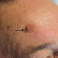
	Seborrhoeic keratosis on the right…
