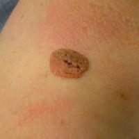 Seborrhoeic keratosis on the right shoulderCopied…