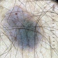Dermoscopic appearance of previous figureCopied…