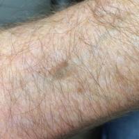 A thin seborrhoeic keratosisLesions that are…