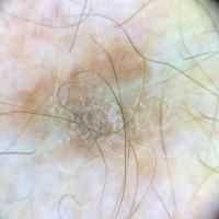 Dermoscopic appearance of the previous figureA…