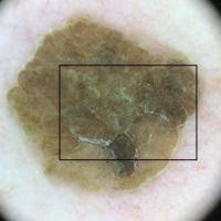 Dermoscopy of previous figureSmall keratin scales…