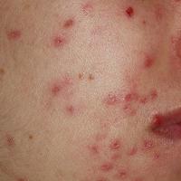 
	DA

	Copied with kind permission from Dermatoweb