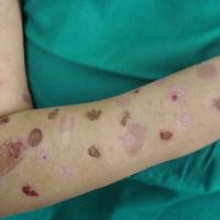 
	DA - caused by superficial burns