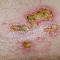 
	DA

	Copied with kind permission from Dermatoweb