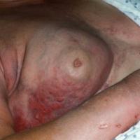 
	Carcinoma erysipeloides secondary to breast…